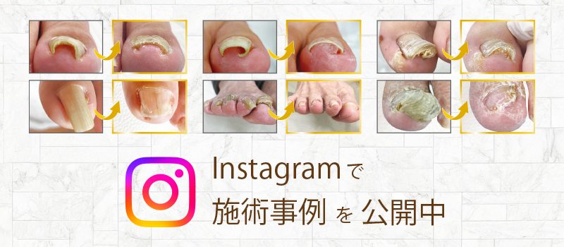 神戸三宮巻き爪センターのインスタグラム
